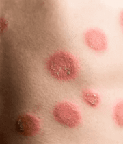 背部红色斑点特写56#横屏 