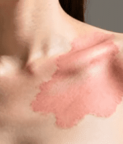 女性肩部皮肤泛红素材6137#横屏 